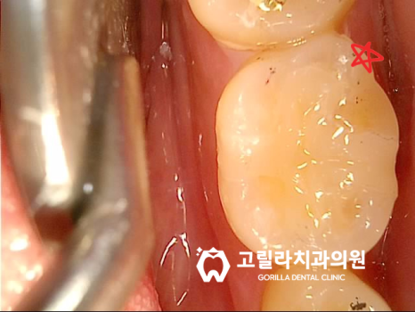 아말감 떼워놓은 것 괜찮은가요? 이미지 5