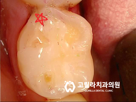 아말감 떼워놓은 것 괜찮은가요? 이미지 3
