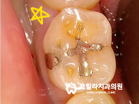 아말감 떼워놓은 것 괜찮은가요?