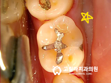 아말감 떼워놓은 것 괜찮은가요? 이미지 4