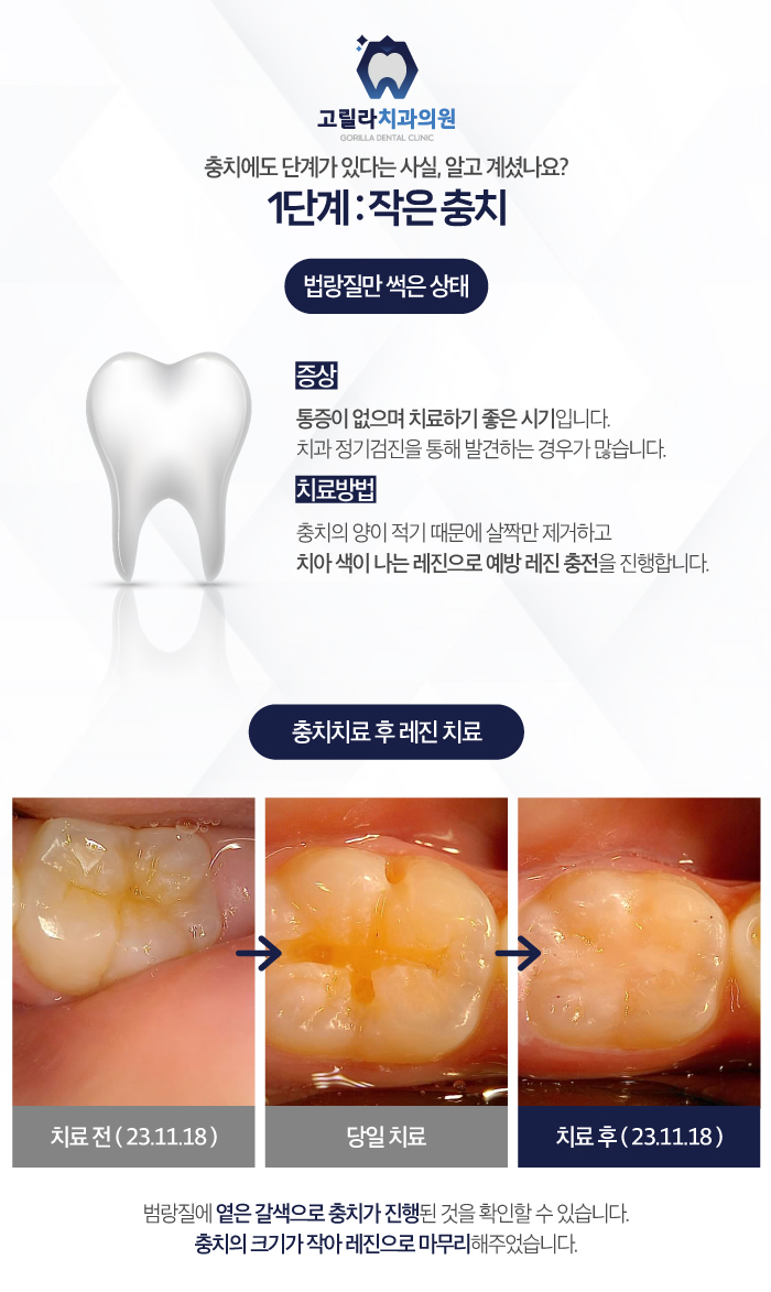 삼가동충치치료의 단계를 고릴라치과에서 확인해보세요!