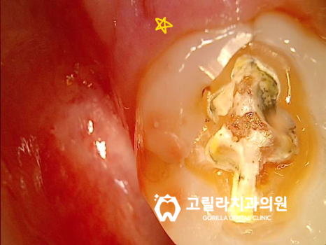 치과치료받은지 오래됐어요, 까매졌어요 이미지 7