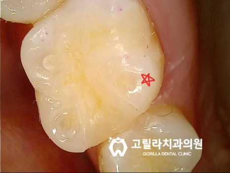 치과치료받은지 오래됐어요, 까매졌어요 이미지 11