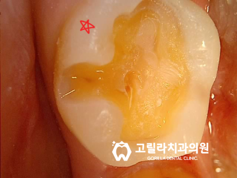 치과치료받은지 오래됐어요, 까매졌어요 이미지 8
