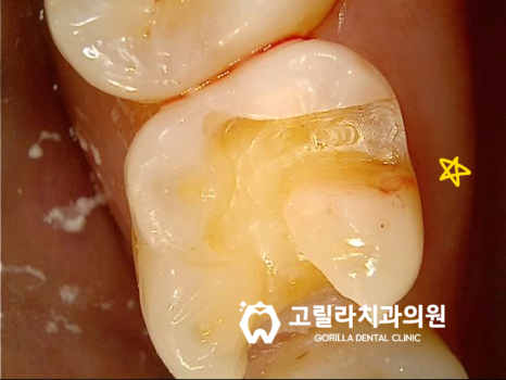 치과치료받은지 오래됐어요, 까매졌어요 이미지 10