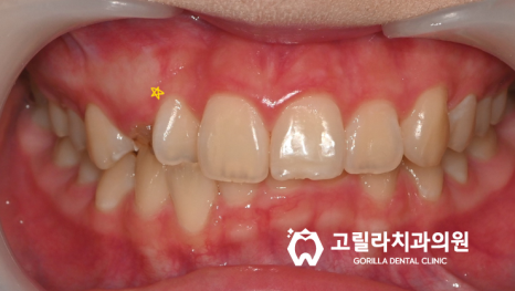 앞니 심미보철, 영구치 없어서 교정말고 보철로 치료원해요