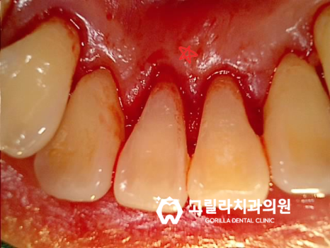 치열이 바르지않아 음식물이 많이 껴요 이미지 10