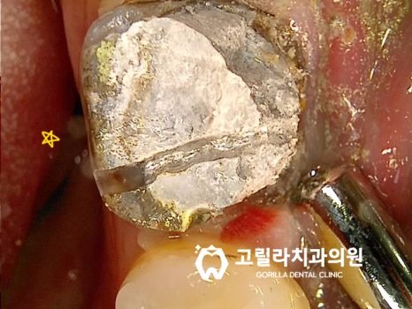 기존보철물 탈락 및 교체시기 이미지 11