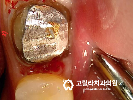기존보철물 탈락 및 교체시기 이미지 12