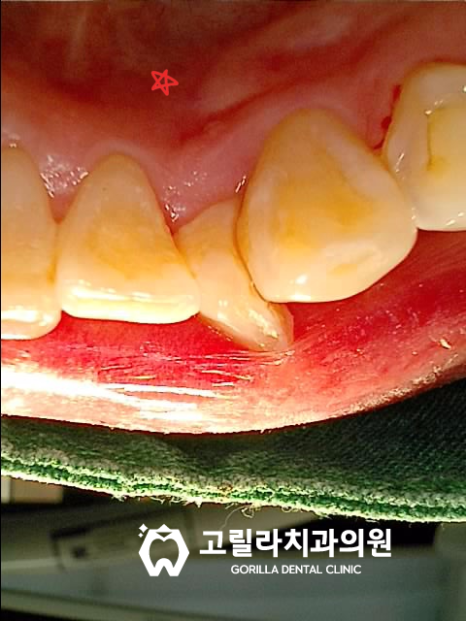 기존보철물 탈락 및 교체시기 이미지 8