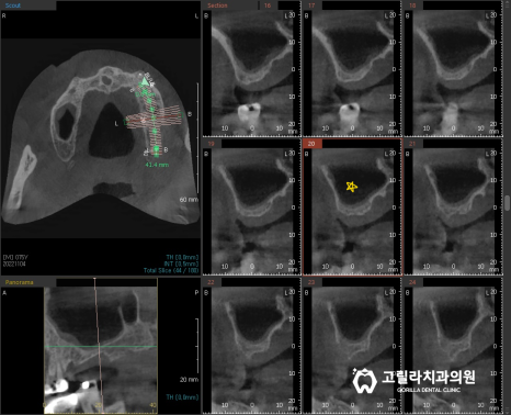다수의 임플란트 및 심미보철 증례 이미지 9