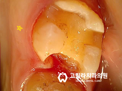 충치치료 레진 vs 인레이 이미지 3