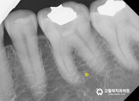 금이간 치아 치료, 씹을 때 시큰거려요