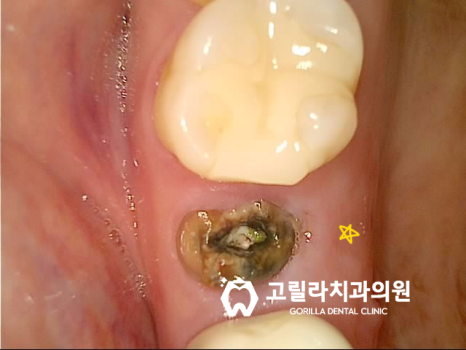 임플란트 수술, 통증을 줄이는 방법 이미지 7