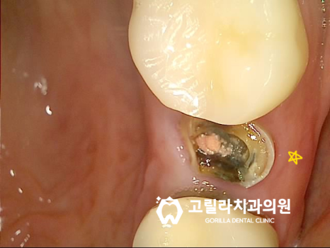 임플란트 수술, 통증을 줄이는 방법 이미지 6