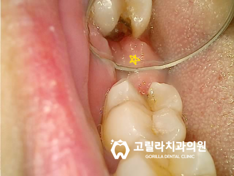 임플란트 보철물 , 2달 완성 이미지 7