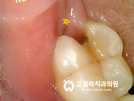 임플란트 보철물 , 2달 완성 이미지 6