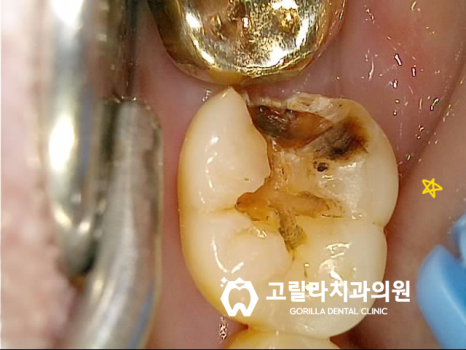 자연치아 보존, 신경치료 안하고 충치치료