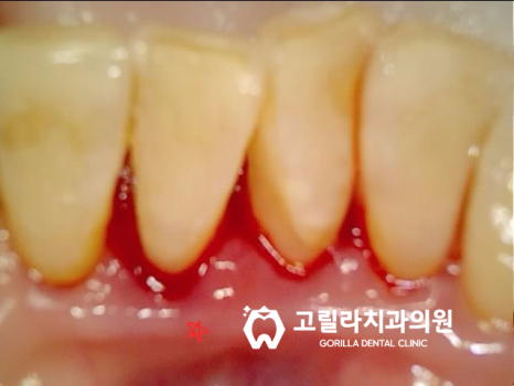 자연치아 보존, 신경치료 안하고 충치치료 이미지 7