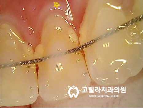 이뺀지 오래된 경우 , 반대 치아가 내려와 치료가 필요합니다. 이미지 8