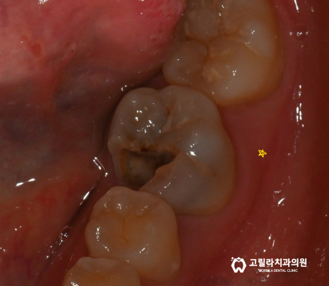 충치로 인한 치아파절