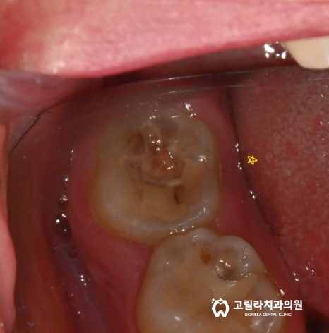 충치로 인한 치아파절 이미지 5
