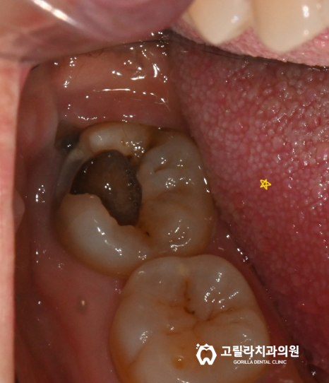 충치로 인한 치아파절 이미지 3