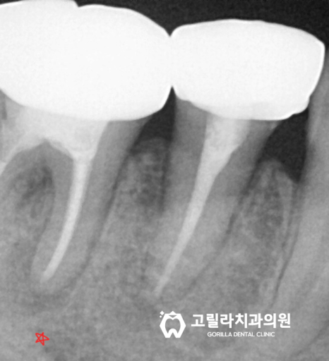 뿌리끝에 염증이 잡힌 재신경치료 이미지 3
