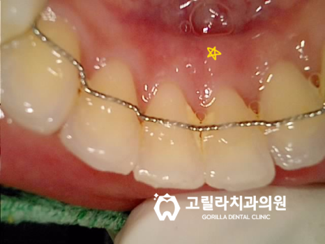 뿌리끝에 염증이 잡힌 재신경치료 이미지 8