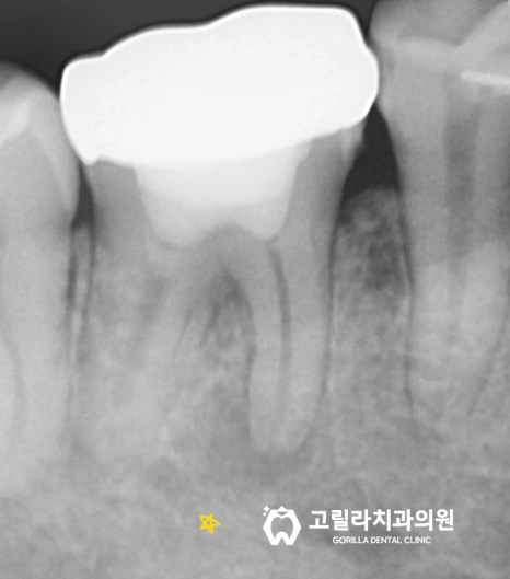 뿌리끝에 염증이 잡힌 재신경치료