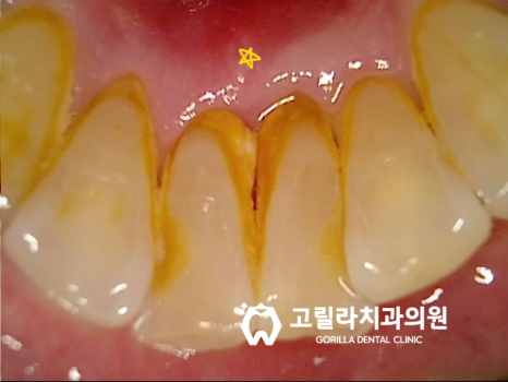 다수의 임플란트 및 브릿지 보철물 이미지 8