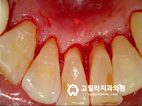 다수의 임플란트 및 브릿지 보철물 이미지 9