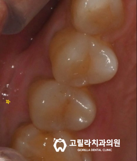 원인 모를 통증있는 치아의 이유는? 이미지 7