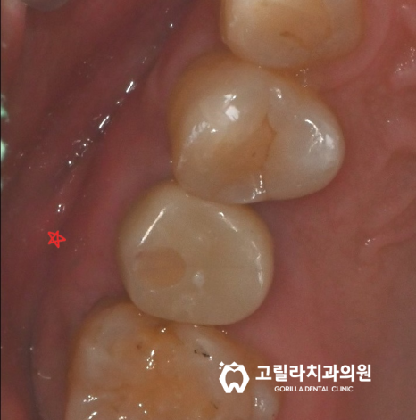 원인 모를 통증있는 치아의 이유는? 이미지 3