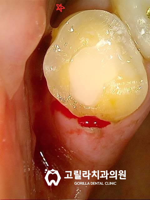 자연치아 보존 / 오래된 보철물 교체 이미지 9