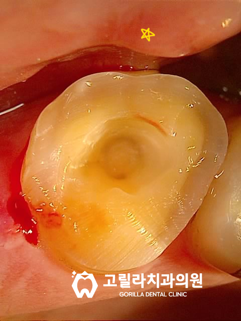 자연치아 보존 / 오래된 보철물 교체 이미지 8
