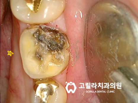 자연치아 보존 / 오래된 보철물 교체