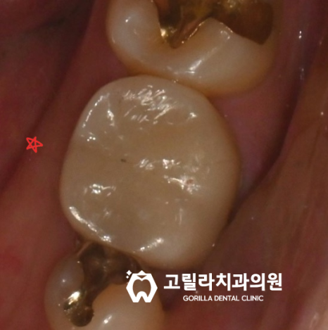 자연치아 보존 / 오래된 보철물 교체 이미지 3