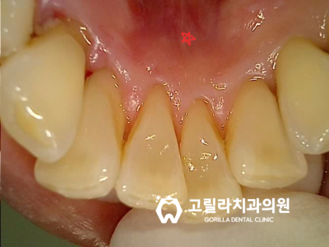 자연치아 살리기 , 잇몸치료의 중요성 이미지 7