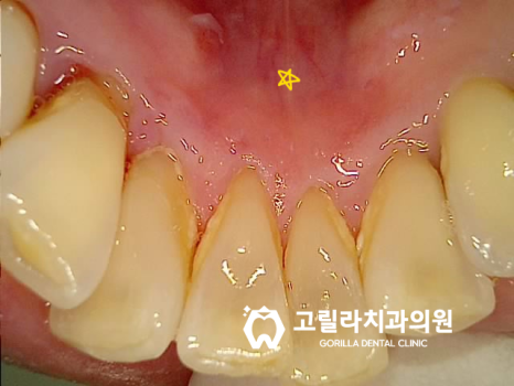 자연치아 살리기 , 잇몸치료의 중요성 이미지 6