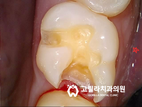충치로 인한 치아파절 치료방법 이미지 3