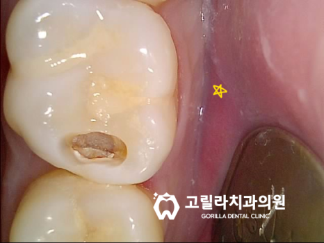 충치로 인한 치아파절 치료방법