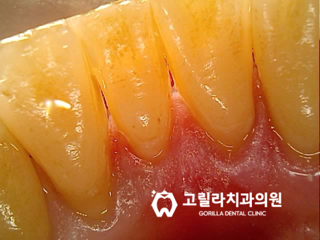 당일 임플란트 수술 - 2달 완성 이미지 6