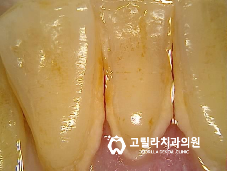 당일 임플란트 수술 - 2달 완성 이미지 5