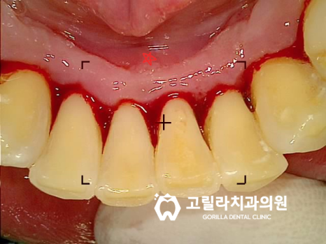 임플란트 혹은 브릿지 치료 선택기준 이미지 9