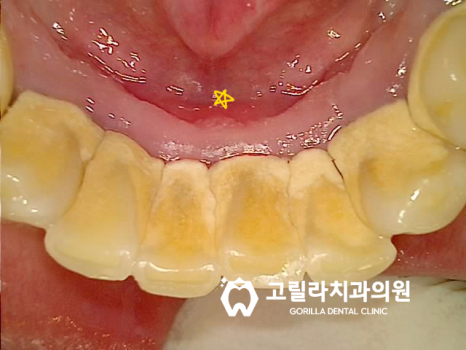 임플란트 혹은 브릿지 치료 선택기준 이미지 8