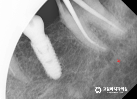 통증을 줄인 임플란트 수술 (+상악동 거상술) 이미지 11