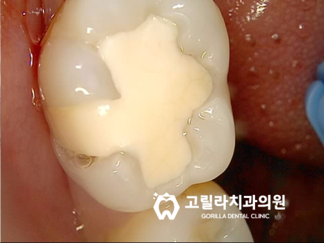오래된 아말감의 교체 - 2차 충치 이미지 11