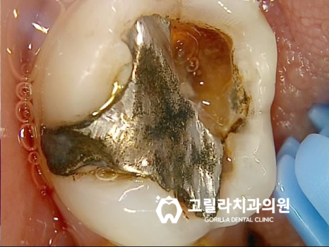 오래된 아말감의 교체 - 2차 충치 이미지 10
