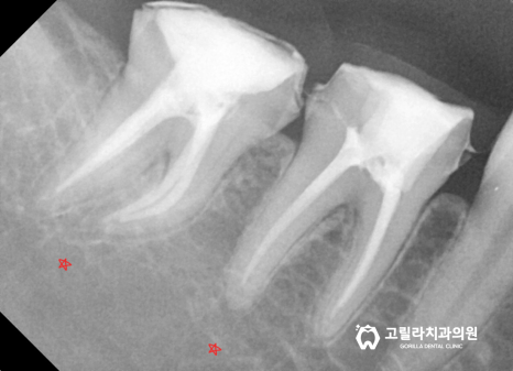 오래된 아말감의 교체 - 2차 충치 이미지 17